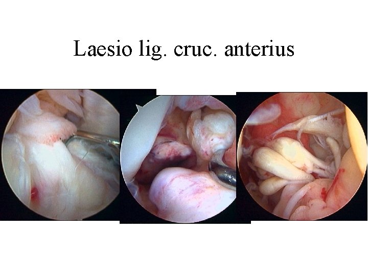 Laesio lig. cruc. anterius 