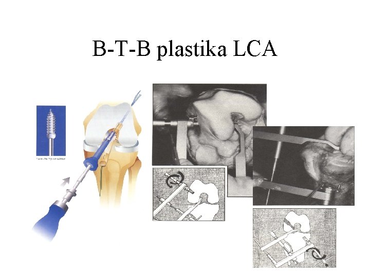 B-T-B plastika LCA 