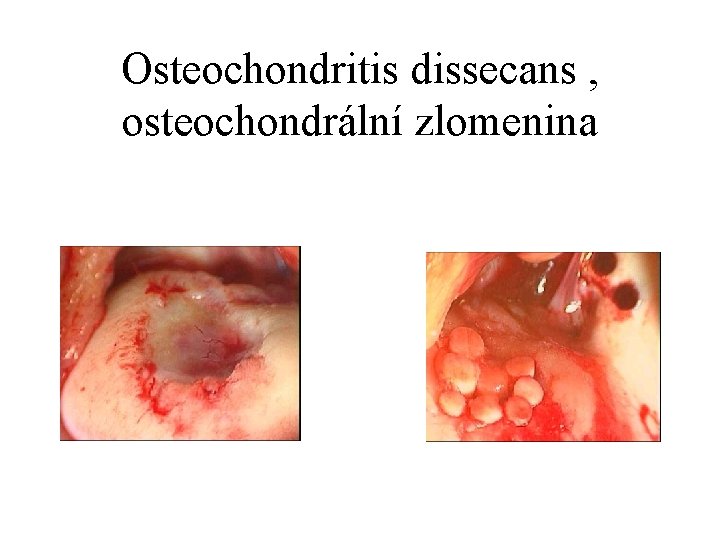 Osteochondritis dissecans , osteochondrální zlomenina 