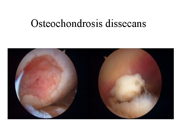 Osteochondrosis dissecans 