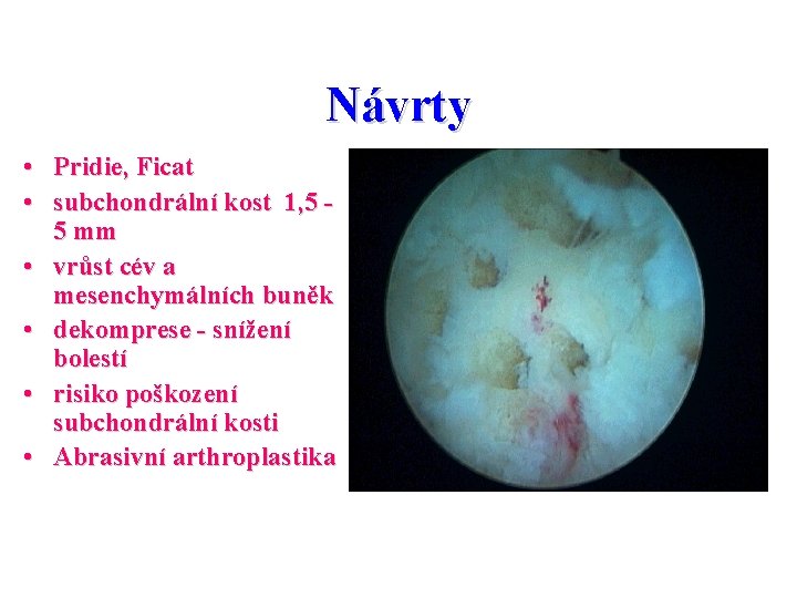 Návrty • Pridie, Ficat • subchondrální kost 1, 5 5 mm • vrůst cév