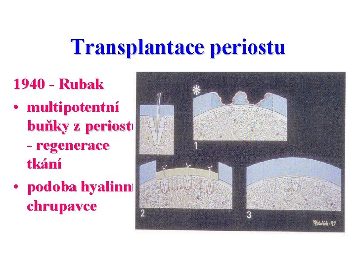 Transplantace periostu 1940 - Rubak • multipotentní buňky z periostu - regenerace tkání •