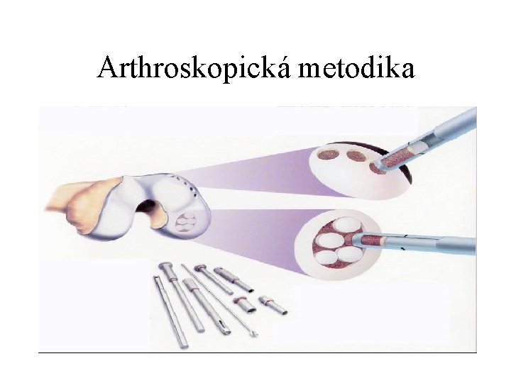 Arthroskopická metodika 