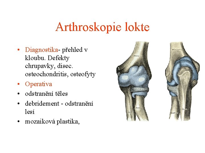 Arthroskopie lokte • Diagnostika- přehled v kloubu. Defekty chrupavky, disec. osteochondritis, osteofyty • Operativa