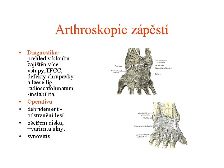 Arthroskopie zápěstí • Diagnostikapřehled v kloubu zajištěn více vstupy, TFCC, defekty chrupavky a laese