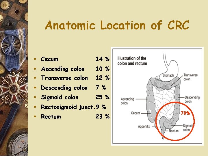 Anatomic Location of CRC w Cecum 14 % w Ascending colon 10 % w