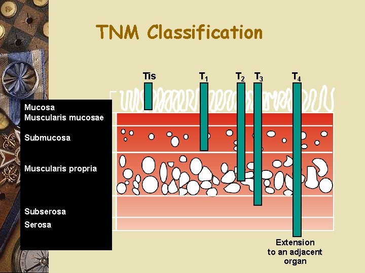 TNM Classification Tis T 1 T 2 T 3 T 4 Mucosa Muscularis mucosae