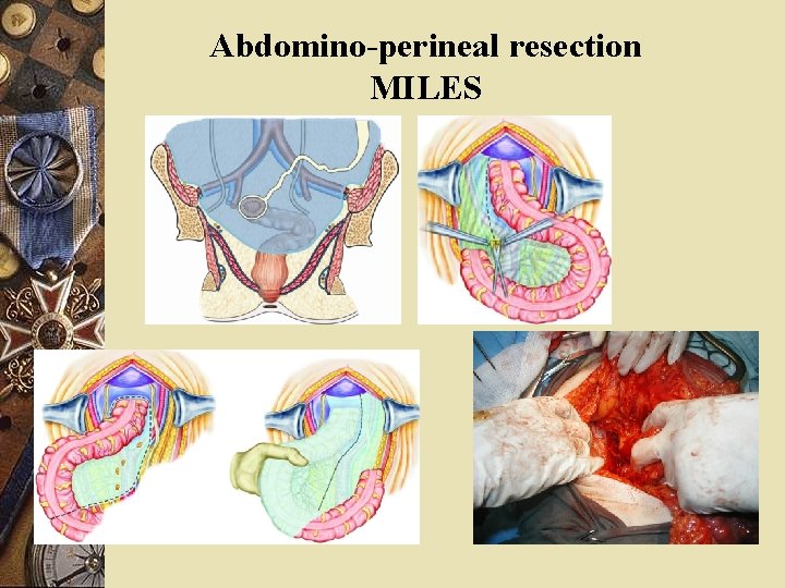 Abdomino-perineal resection MILES 