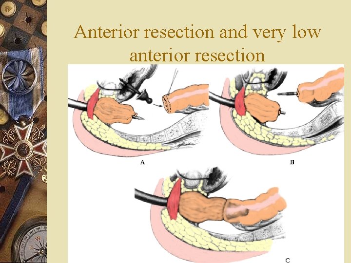 Anterior resection and very low anterior resection 
