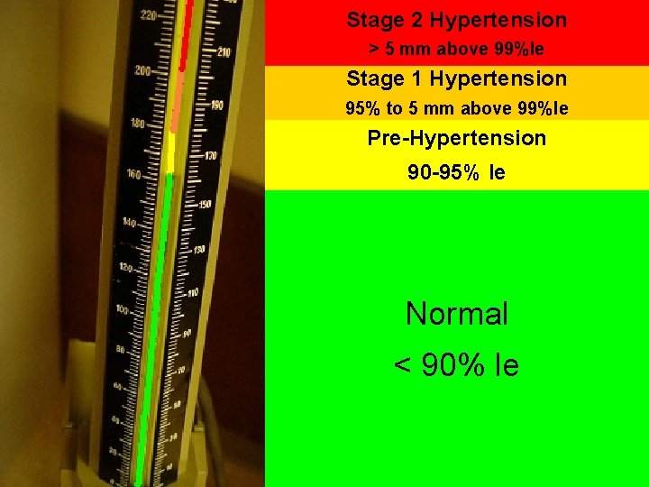 Stage 2 Hypertension > 5 mm above 99%le Stage 1 Hypertension 95% to 5