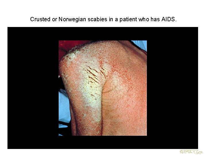 Crusted or Norwegian scabies in a patient who has AIDS. 