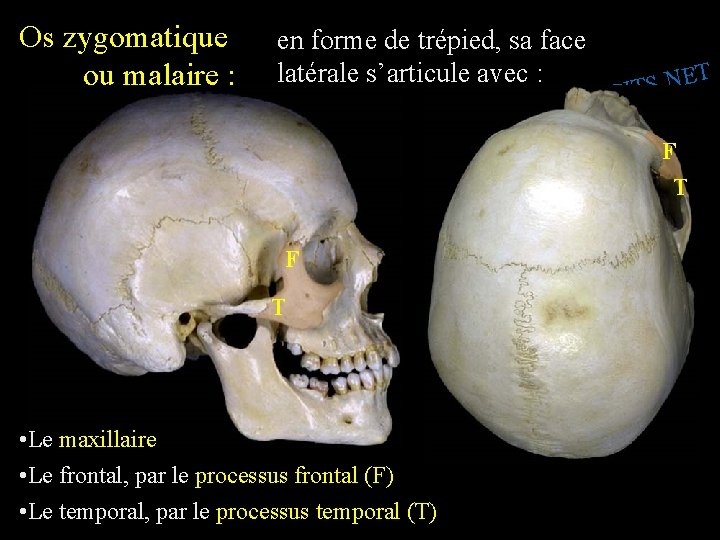 Os zygomatique ou malaire : en forme de trépied, sa face latérale s’articule avec