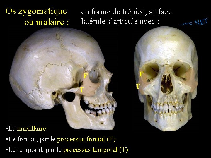 Os zygomatique ou malaire : en forme de trépied, sa face latérale s’articule avec