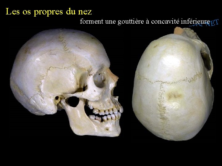 Les os propres du nez forment une gouttière à concavité inférieure T E N.