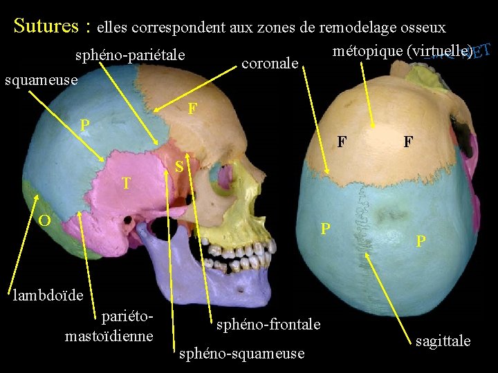 Sutures : elles correspondent aux zones de remodelage osseux sphéno-pariétale squameuse métopique (virtuelle) T