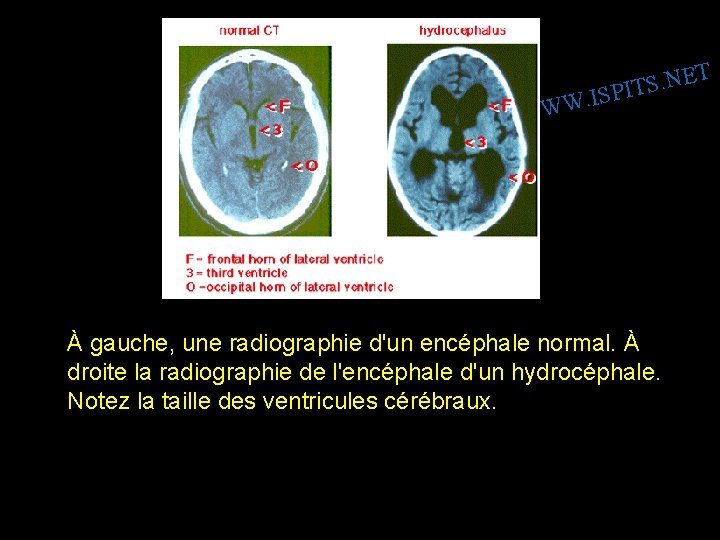 T E N. S SPIT I. W W W À gauche, une radiographie d'un