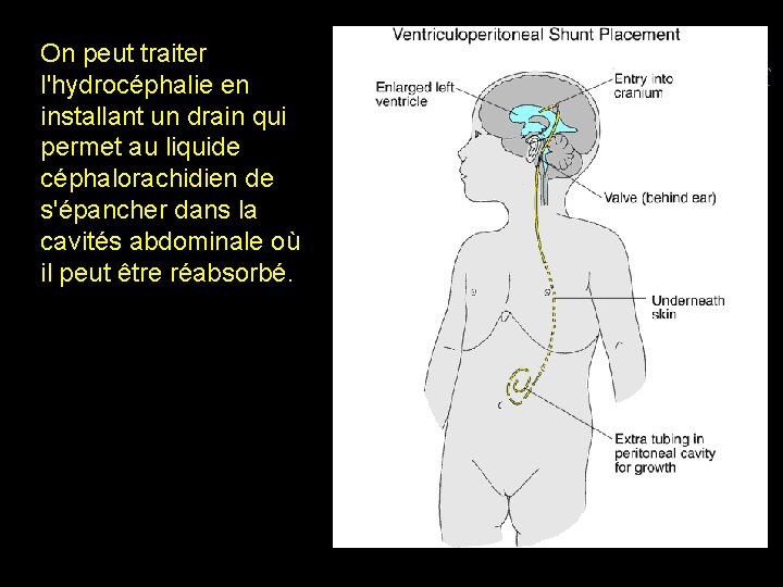 On peut traiter l'hydrocéphalie en installant un drain qui permet au liquide céphalorachidien de