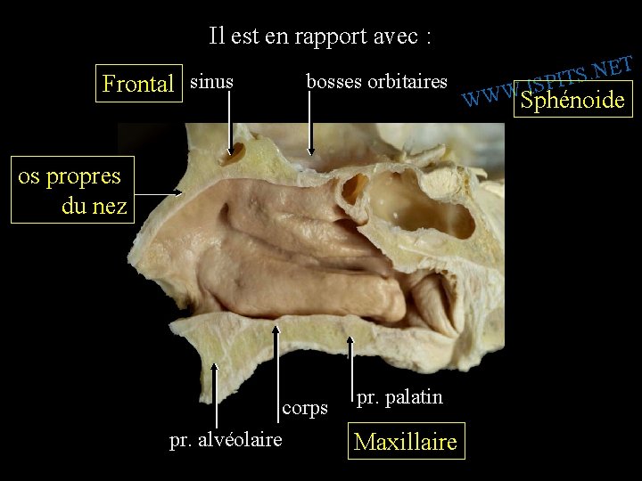 Il est en rapport avec : Frontal sinus bosses orbitaires os propres du nez