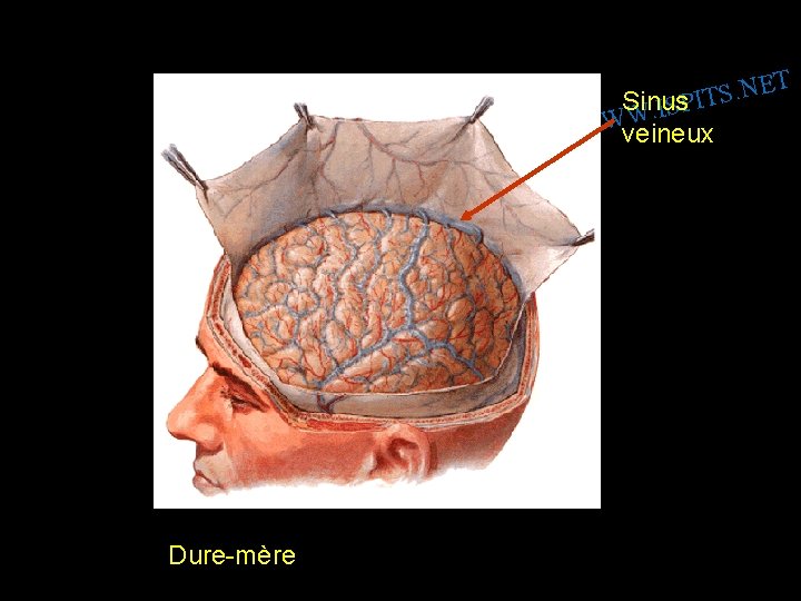 T E N. S Sinus SPIT I. W WWveineux Dure-mère 