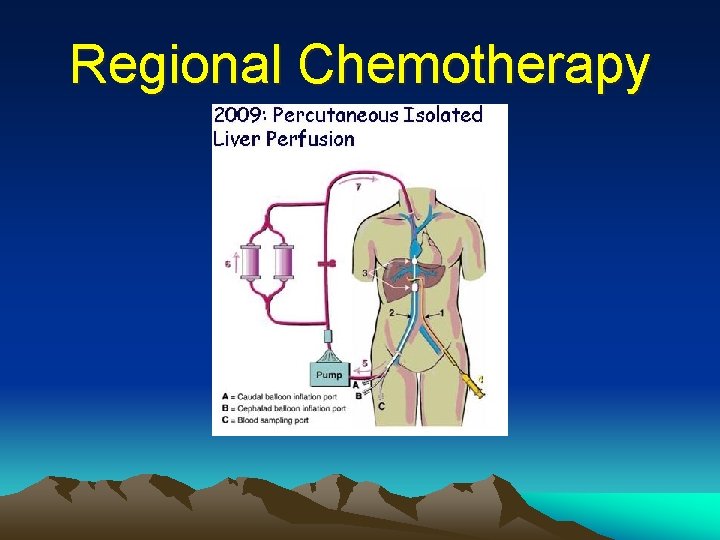 Regional Chemotherapy 