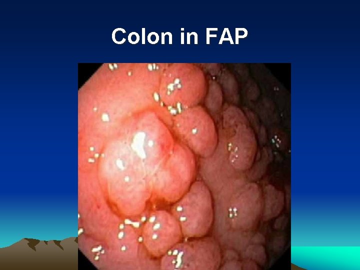 Colon in FAP 