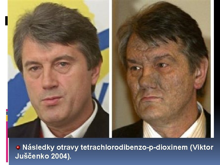 Následky otravy tetrachlorodibenzo-p-dioxinem (Viktor Juščenko 2004). 