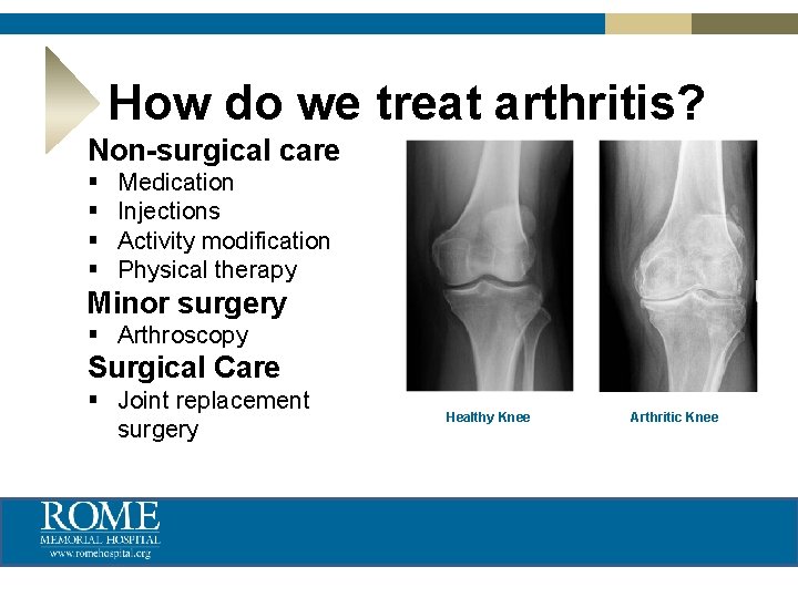 How do we treat arthritis? Non-surgical care § § Medication Injections Activity modification Physical