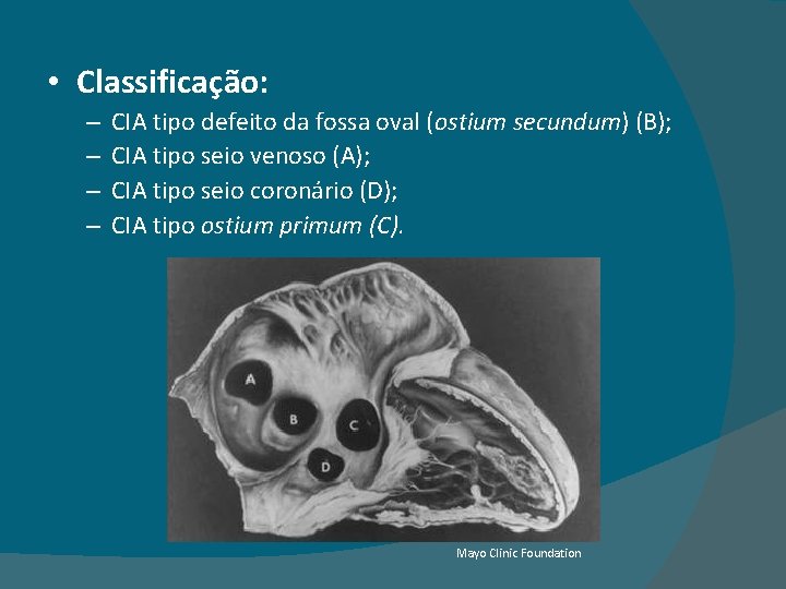  • Classificação: – – CIA tipo defeito da fossa oval (ostium secundum) (B);