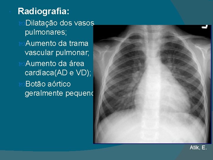  Radiografia: Dilatação dos vasos pulmonares; Aumento da trama vascular pulmonar; Aumento da área