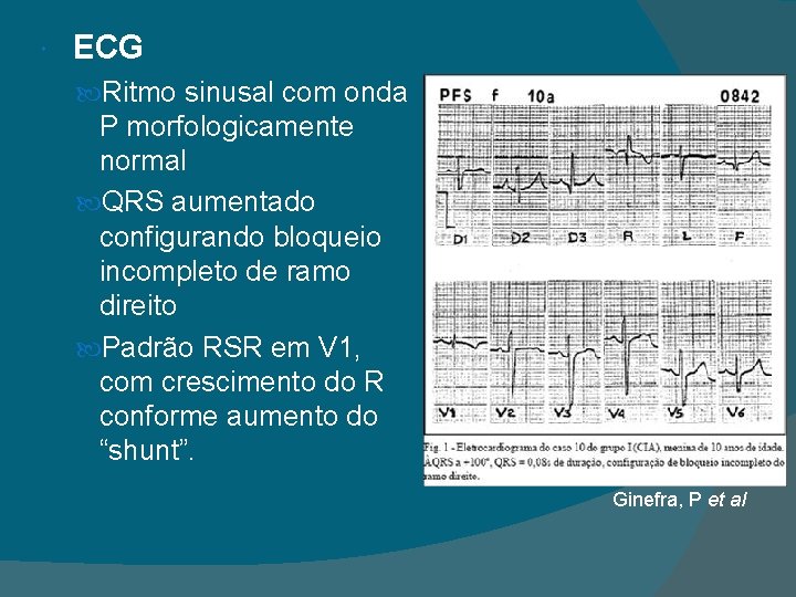  ECG Ritmo sinusal com onda P morfologicamente normal QRS aumentado configurando bloqueio incompleto