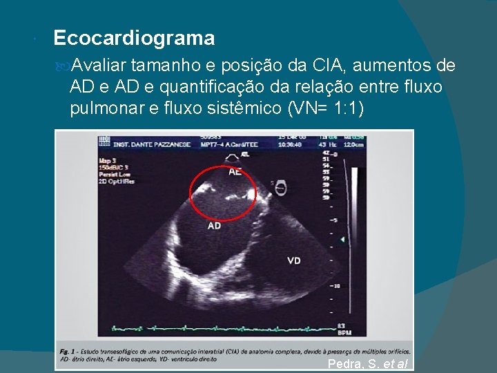  Ecocardiograma Avaliar tamanho e posição da CIA, aumentos de AD e quantificação da