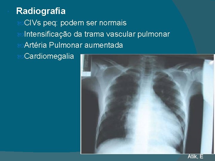  Radiografia CIVs peq: podem ser normais Intensificação da trama vascular pulmonar Artéria Pulmonar
