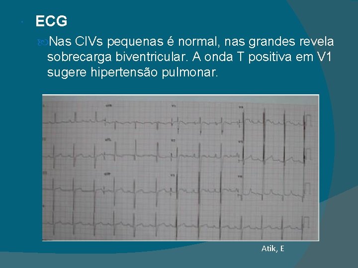  ECG Nas CIVs pequenas é normal, nas grandes revela sobrecarga biventricular. A onda