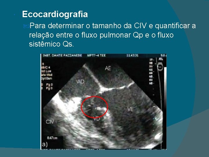  Ecocardiografia Para determinar o tamanho da CIV e quantificar a relação entre o