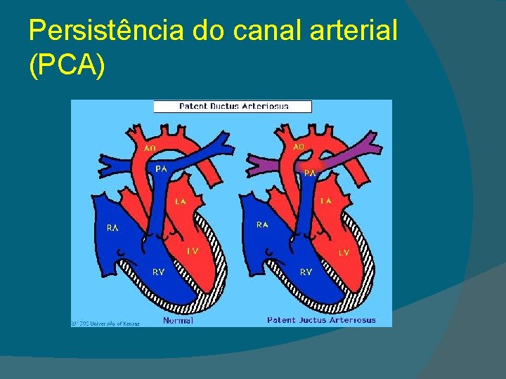 Persistência do canal arterial (PCA) 