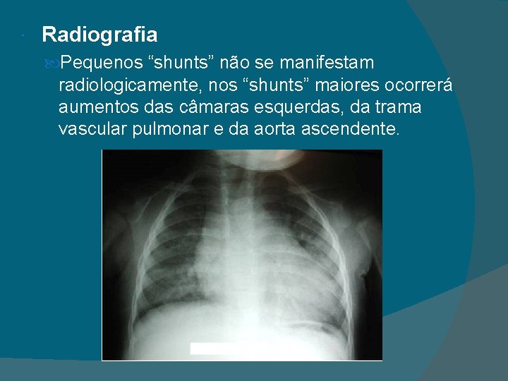  Radiografia Pequenos “shunts” não se manifestam radiologicamente, nos “shunts” maiores ocorrerá aumentos das