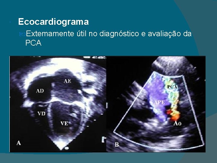 Ecocardiograma Extemamente útil no diagnóstico e avaliação da PCA 