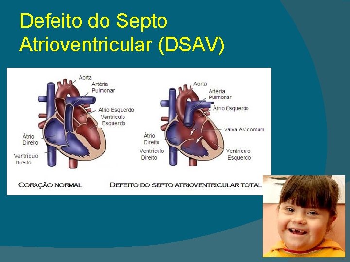 Defeito do Septo Atrioventricular (DSAV) 