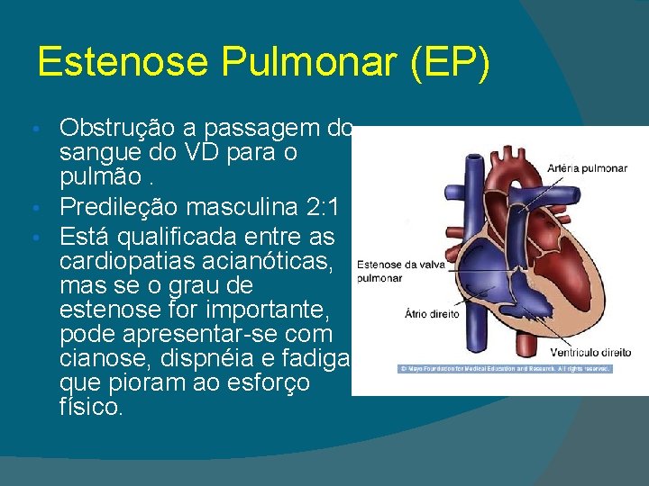 Estenose Pulmonar (EP) Obstrução a passagem do sangue do VD para o pulmão. •