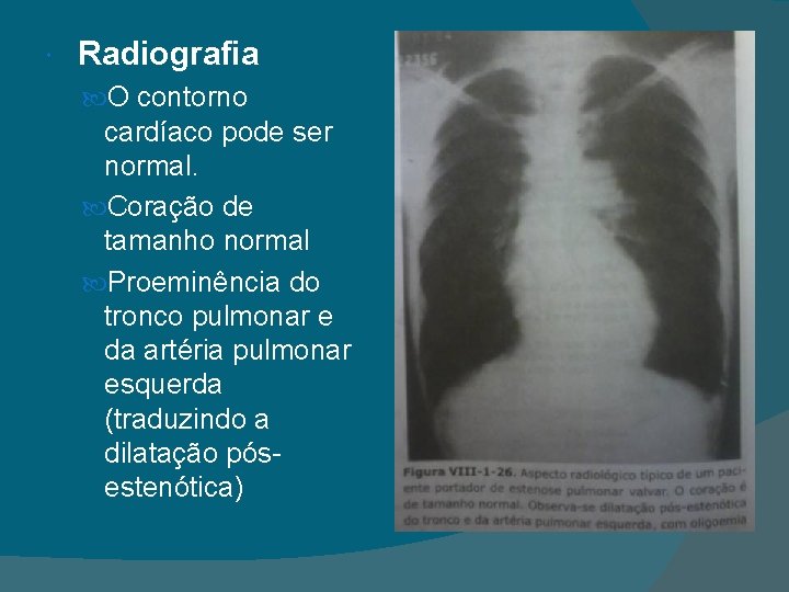  Radiografia O contorno cardíaco pode ser normal. Coração de tamanho normal Proeminência do