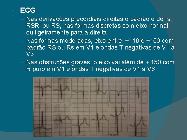  • ECG – Nas derivações precordiais direitas o padrão é de rs, RSR’