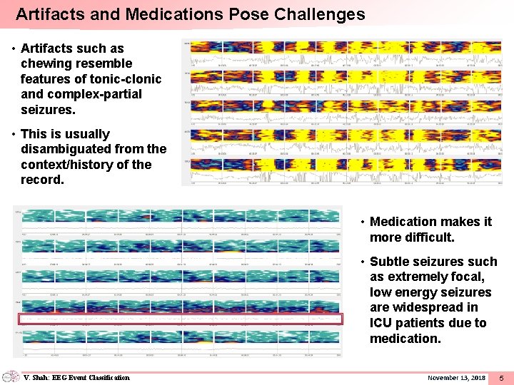 Artifacts and Medications Pose Challenges • Artifacts such as chewing resemble features of tonic-clonic