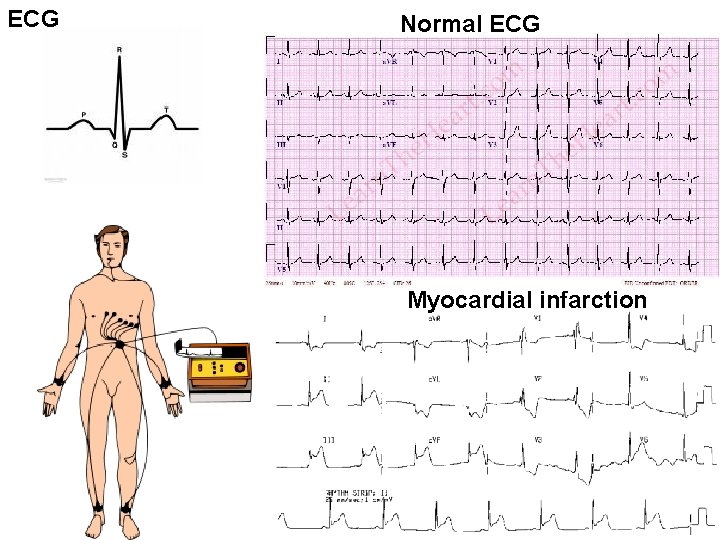 ECG Normal ECG Myocardial infarction ECG Normal ECG Myocardial infarction