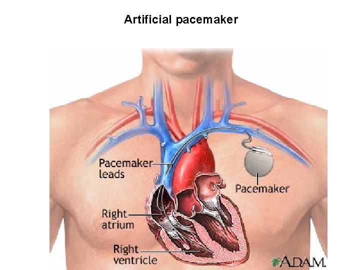 Artificial pacemaker Artificial pacemaker