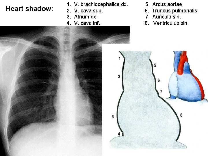 Heart shadow: 1. 2. 3. 4. V. brachiocephalica dx. V. cava sup. Atrium dx. Heart shadow: 1. 2. 3. 4. V. brachiocephalica dx. V. cava sup. Atrium dx.