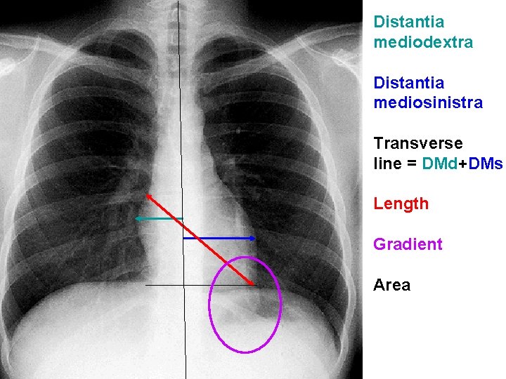 Distantia mediodextra Distantia mediosinistra Transverse line = DMd+DMs Length Gradient Area Distantia mediodextra Distantia mediosinistra Transverse line = DMd+DMs Length Gradient Area