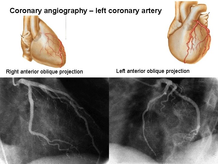 Coronary angiography – left coronary artery Right anterior oblique projection Left anterior oblique projection Coronary angiography – left coronary artery Right anterior oblique projection Left anterior oblique projection