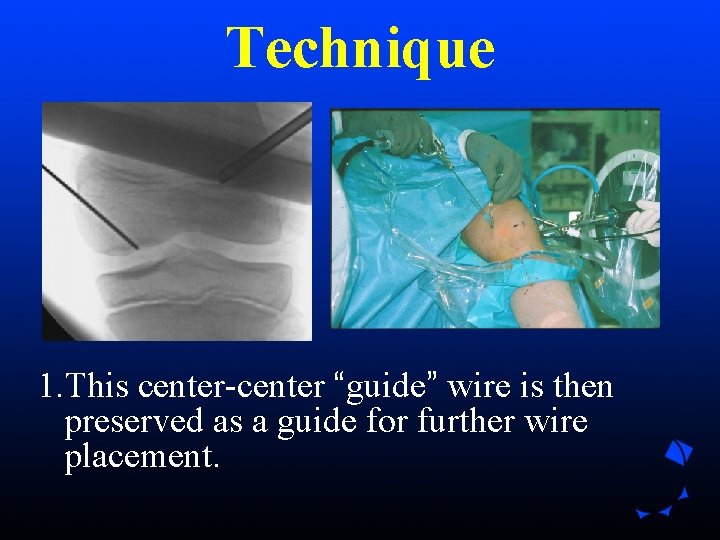 Technique 1. This center-center “guide” wire is then preserved as a guide for further Technique 1. This center-center “guide” wire is then preserved as a guide for further