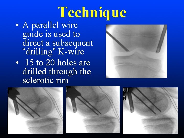 Technique • A parallel wire guide is used to direct a subsequent “drilling” K-wire Technique • A parallel wire guide is used to direct a subsequent “drilling” K-wire