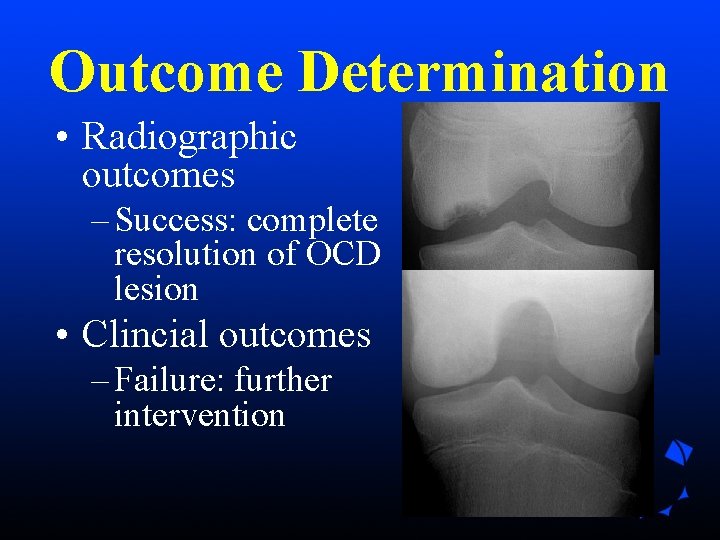 Outcome Determination • Radiographic outcomes – Success: complete resolution of OCD lesion • Clincial Outcome Determination • Radiographic outcomes – Success: complete resolution of OCD lesion • Clincial